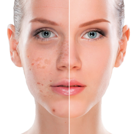 Reduceer hyperpigmentatie, ouderdomsvlekjes en pigment en verhelder je huid