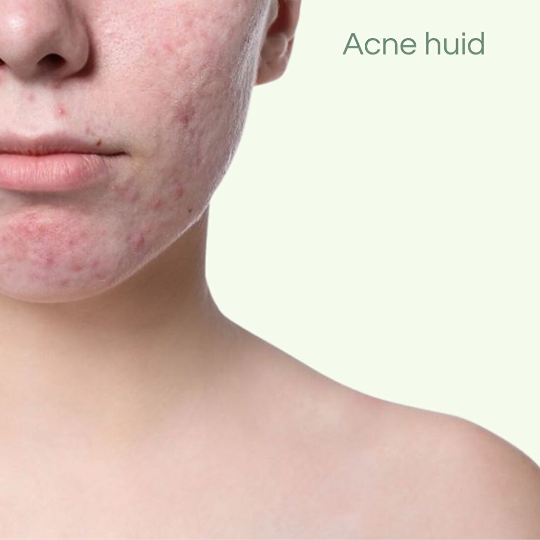 natuurlijke huidverzorging acnehuid