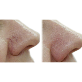 Muisdoorn serum Plus