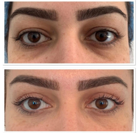 Ogentroost liposome serum