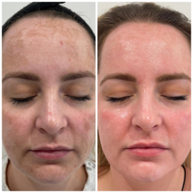Anti-pigment pakket