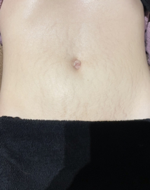 Effectieve striae behandeling