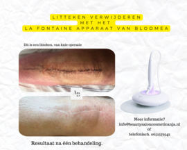 Effectieve littekenbehandeling ( kuur van 10 behandelingen )