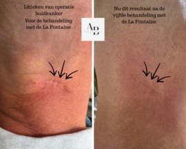 Effectieve littekenbehandeling ( kuur van 10 behandelingen )