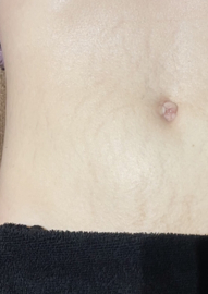 Effectieve striae behandeling