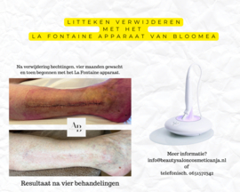 Effectieve littekenbehandeling ( kuur van 10 behandelingen )