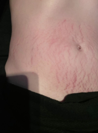 Effectieve striae behandeling