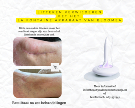 Effectieve littekenbehandeling ( kuur van 10 behandelingen )