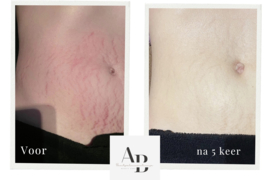Effectieve striae behandeling