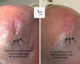 Effectieve littekenbehandeling ( kuur van 10 behandelingen )