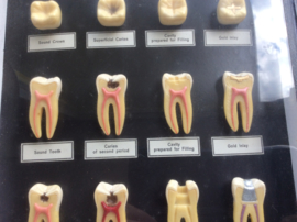 Tanden, Conservation of decayed teeth