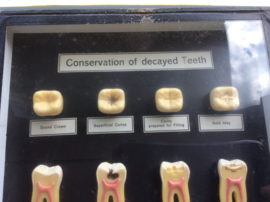 Tanden, Conservation of decayed teeth