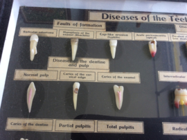 Tanden, Diseases of the teeth  (Nr. 2)