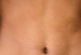 Acne en Microbioom
