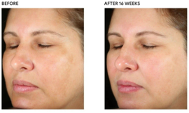 PCA Skin Pigment Gel Pro 30 ml