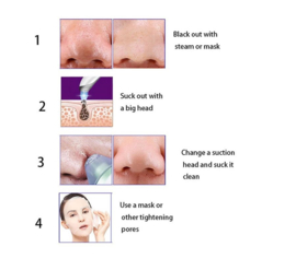 Blackhead remover acne puistjes mee eter verwijderen *2 kleuren*