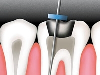 POLYDENTIA ENDO STOPS