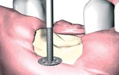MEISINGER SAW BASIC KIT