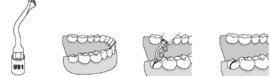 WP CHIRURGIE TIP TITAN US1
