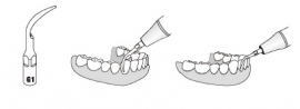 WP TANDSTEEN TIP TITAN G1T