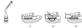 WP CHIRURGIE TIP TITAN US2