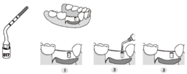 WP CHIRURGIE TIP DIAMOND UI7