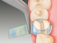 DISPENS-O-MAT MOLAR