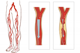 Fysiotherapie bij Claudicatio intermittens