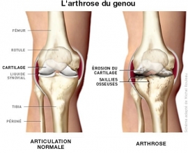 Arthrose