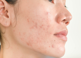 Acne behandeling