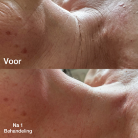 Kuur  behandeling gezicht, hals en decolleté 5 en 1 gratis