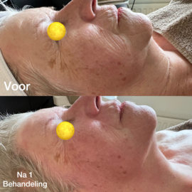 Kuur  behandeling gezicht, hals en decolleté 5 en 1 gratis