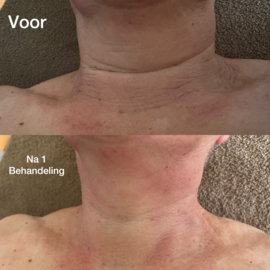 Kuur  behandeling gezicht, hals en decolleté 5 en 1 gratis