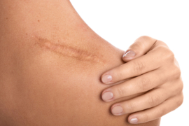 opleiding | LITTEKEN CORRECTIE NEEDLING