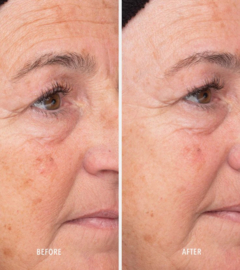 Liquid Resurfacing Solution