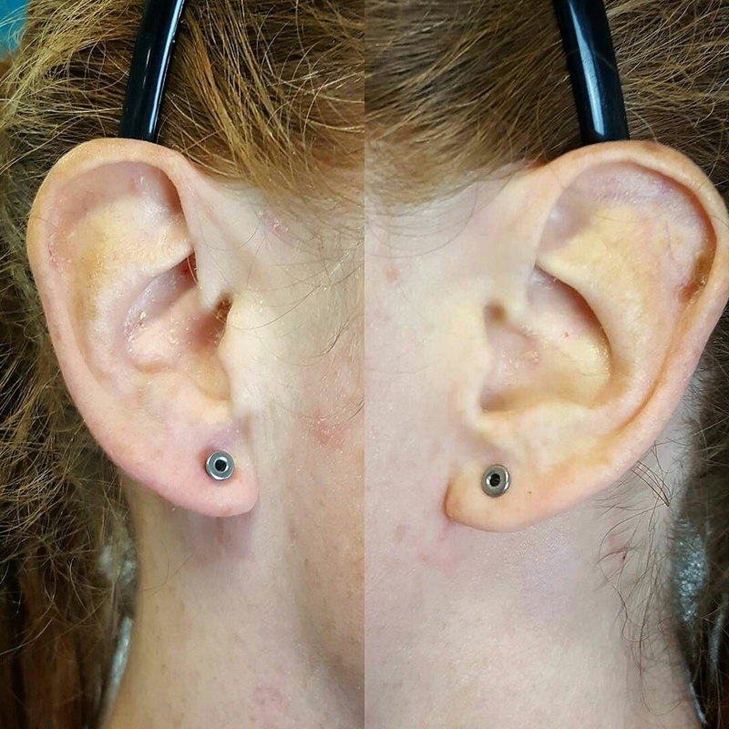 titanium ear tunnels