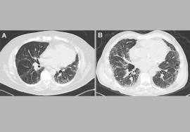 Longfibrose | Longfibrose van onbekende oorsprong (IPF)