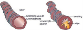 Irritatie in luchtwegen het begin van COPD