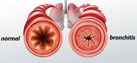 Chronische Bronchitis en longemfyseem valt samen onder de noemer COPD.