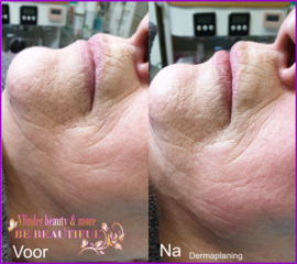 VOOR EN NA FOTO DERMAPLANING