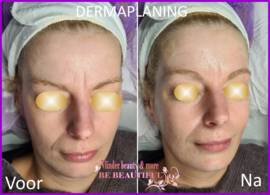 VOOR EN NA FOTO DERMAPLANING