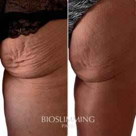 VOOR EN NA FOTO'S BIOSLIMMING 2