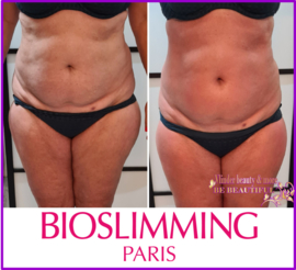 VOOR EN NA FOTO'S BIOSLIMMING 1