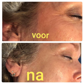 Carboxy CO2 therapy