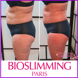 VOOR EN NA FOTO'S BIOSLIMMING 1