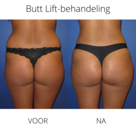 Vacuüm Cupping Bodydrainer  Brazilian Butt- lifting