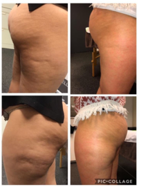 Kus je cellulite vaarwel! Benen, Billen Cupping  € 45,00