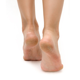 Feetcalm Eelt en harde huid spray 20% Ureum  75 ml