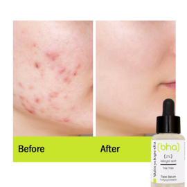 Gesichtsserum gegen Mitesser, Pickel und rote Beulen 30 ml