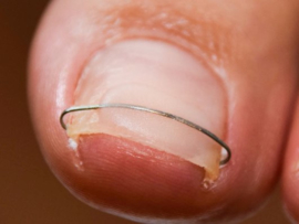 Nagelbeugel draad 0.4mm